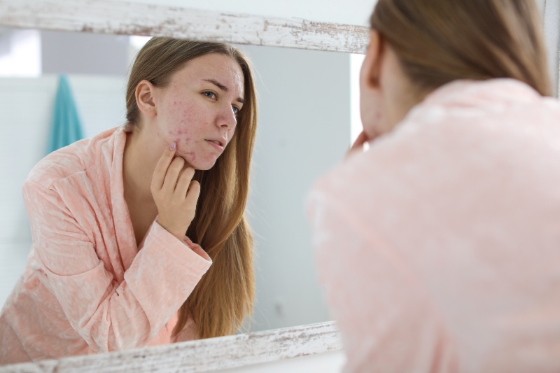 Woman with Acne Problem | Stress Symptoms