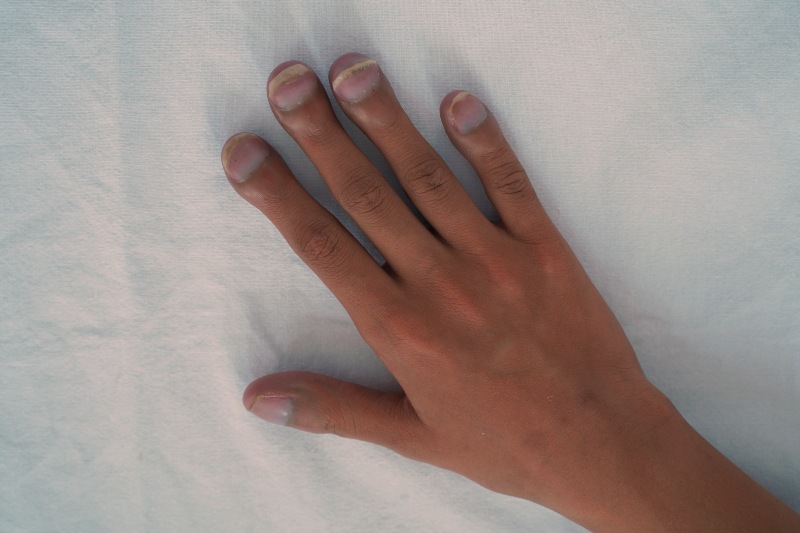 Clubbing Fingers | Liver Cirrhosis