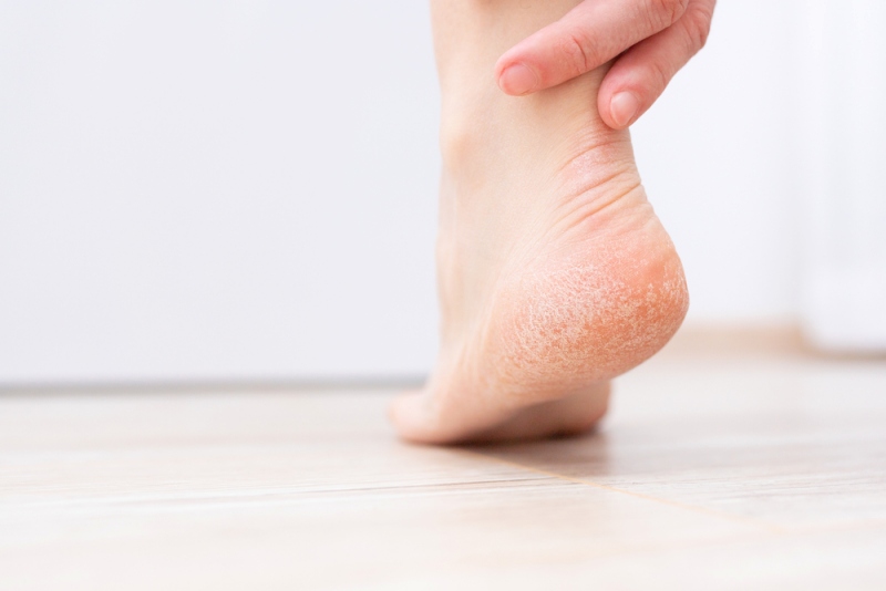 dry skin on heel cracked treatment | sign of liver problems