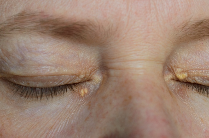 Eyes with Xanthelasma | Liver Cirrhosis