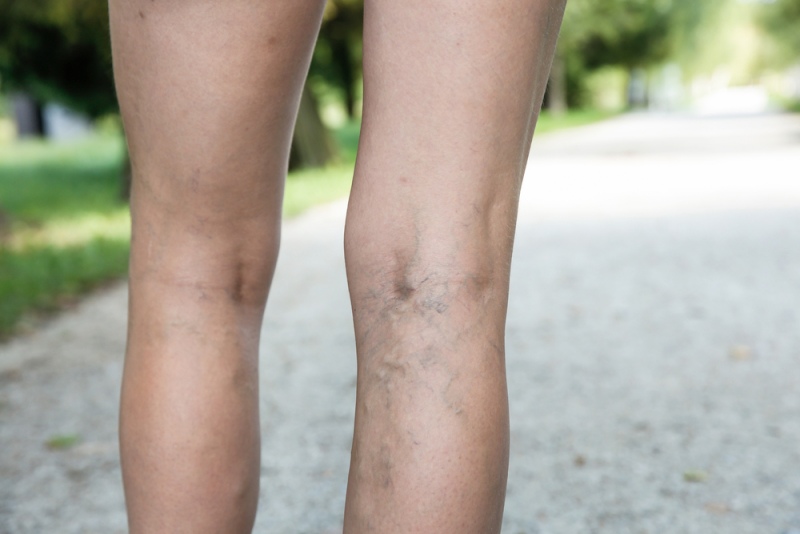 painful varicose spider veins on womans | liver problems signs
