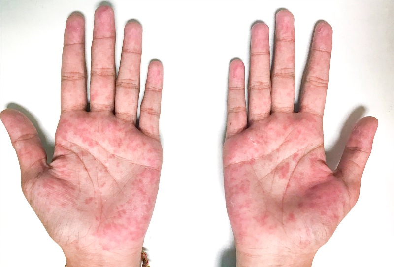 Rashes on Both Palms | Liver Cirrhosis