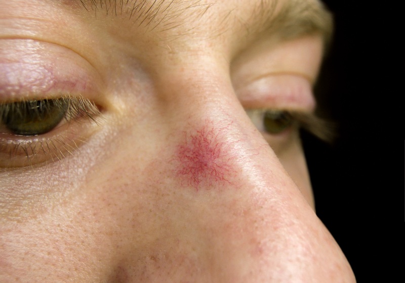 Spider Angioma on the Skin of the Nose | Liver Cirrhosis