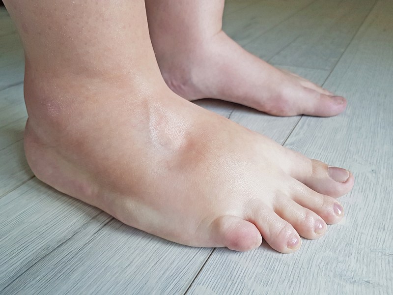 swollen feets because water retention body | sign of kidney problems