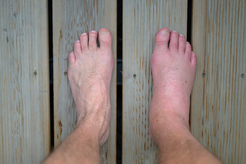 Swollen Inflamed Foot of a Man | Liver Cirrhosis