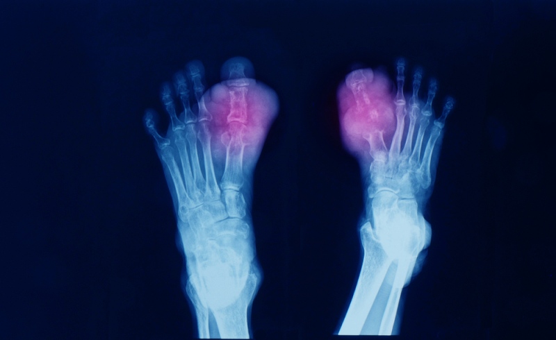 xray both foot showing bone erosion | uric acid level