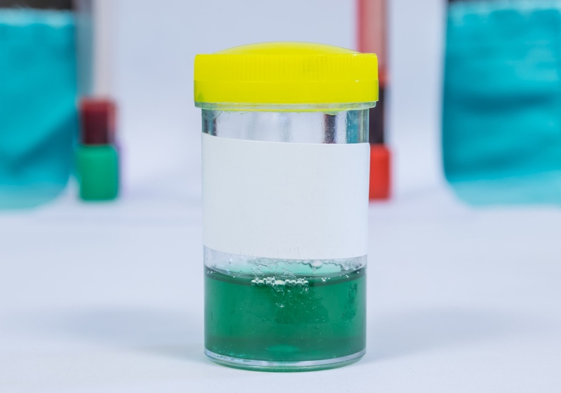 Green urine Pee Color Meaning Green and clear of Urine specimen for urine examination in laboratory.