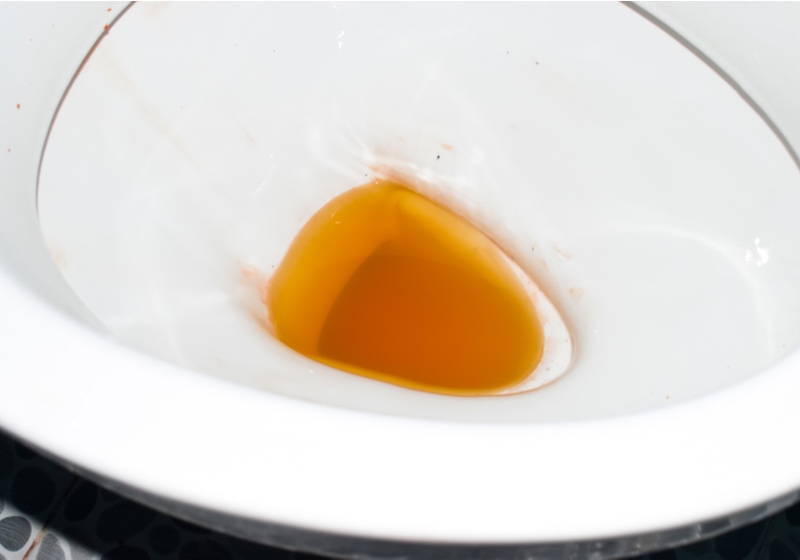 Orange Urine Color | Pee Color Meaning | High coloured urine in toilet. High colored urine occurs in hepatitis, leptospirosis disease, hemolytic diseases and some drug taking