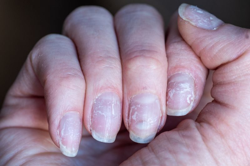 Close up brittle nails damage nail after using shellac | Nail problems due to vitamin deficiency