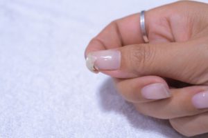 Nail Problems Due To Vitamin Deficiency | Mighty Goodness