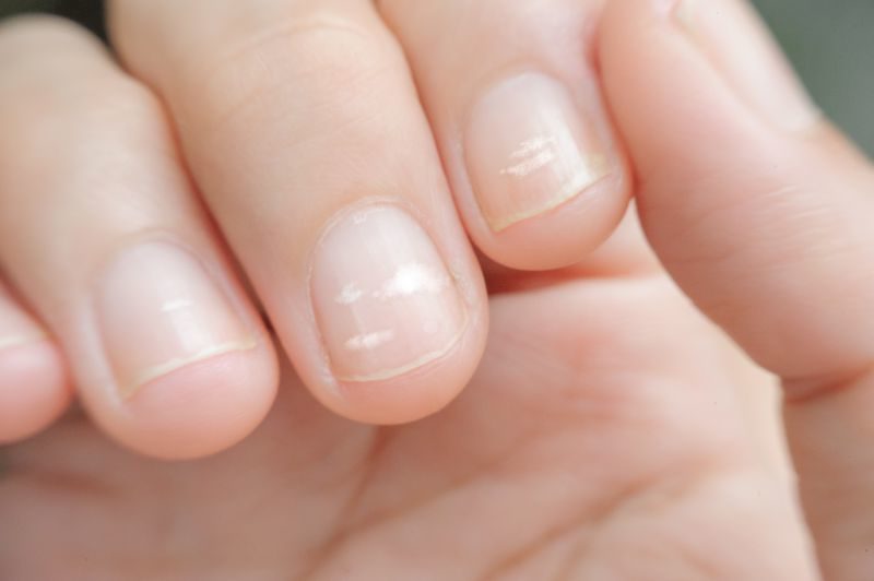 Close up white spot finger nails called leukonychia | Nail problems due to vitamin deficiency