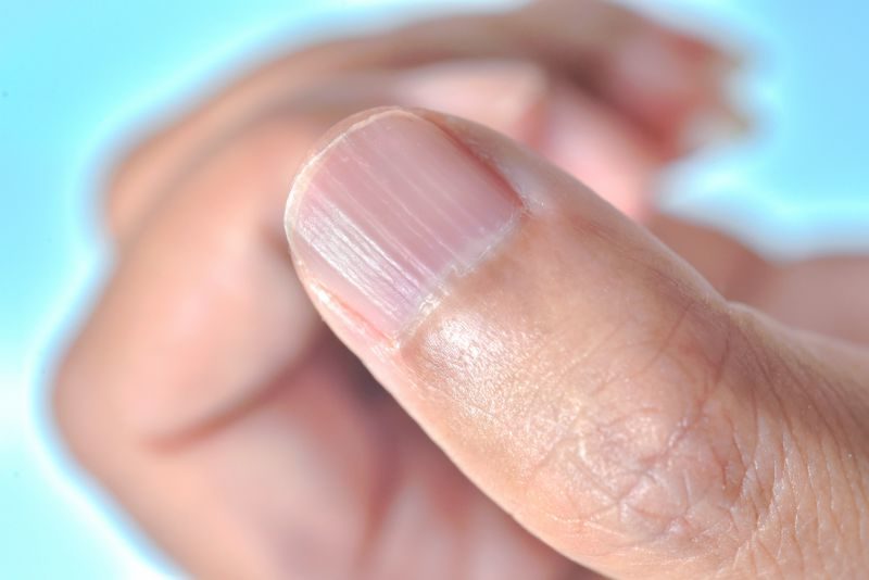 Longitudinal ridging nail | Nail problems due to vitamin deficiency