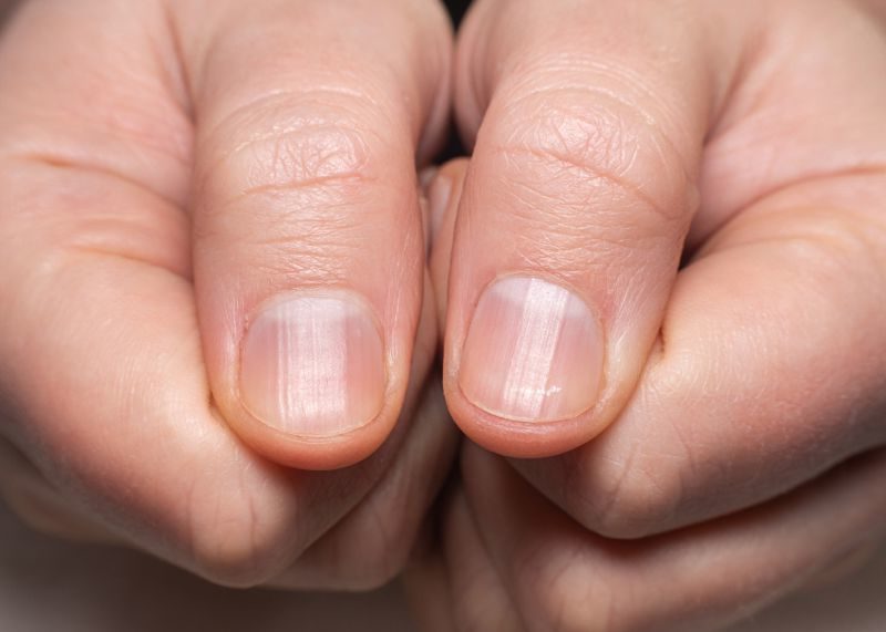Right left hand showing ridged nails thumbs | Nail problems due to vitamin deficiency