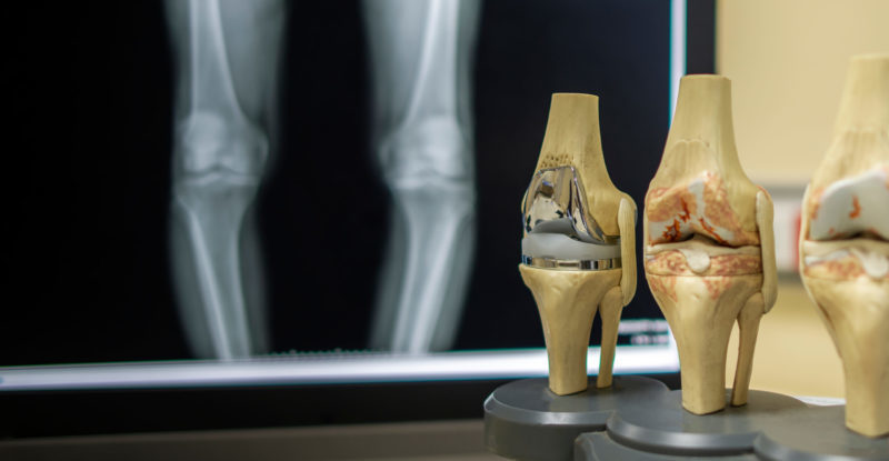 The model of knee joint shown the process of osteoarthritis of knee and total knee replacement surgery | health benefits of curcumin