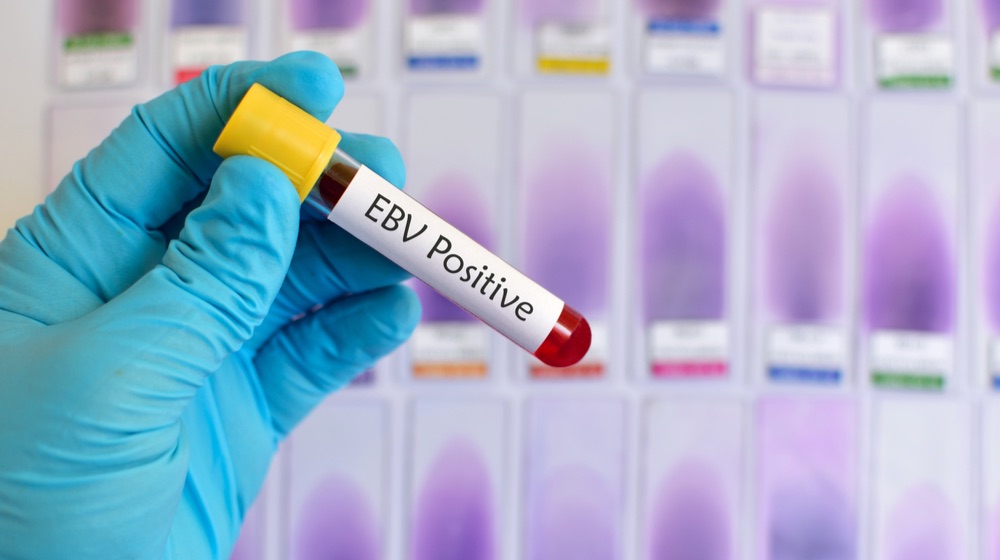 Blood sample positive with Epstein-Barr virus (EBV) | Epstein Barr Virus Multiple Sclerosis