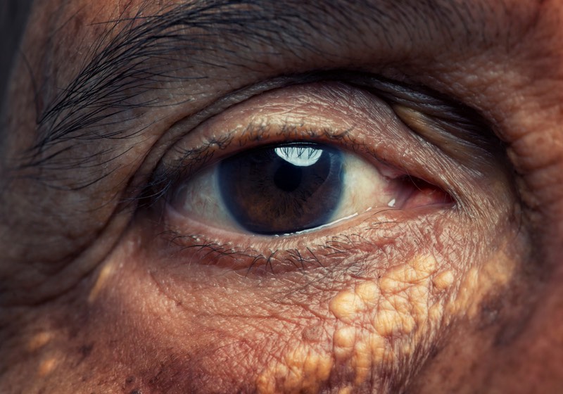 Close up Eye of Old women with high Cholesterol skin sign | Skin Manifestations | Xanthelasma | High Cholesterol Eye Bumps