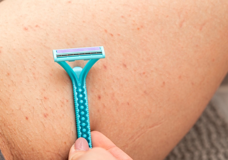 Close up picture of woman holding razor, shaving her hairy leg with folliculitis | PCOS Skin Problems | Skin Manifestations of PCOS Hyperandrogen