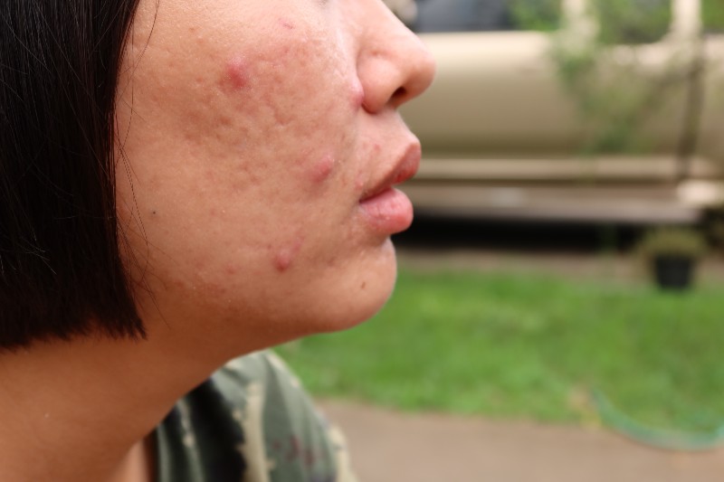 Close up the face skin Asian young women are acne, facial skin, acne | Carb Face