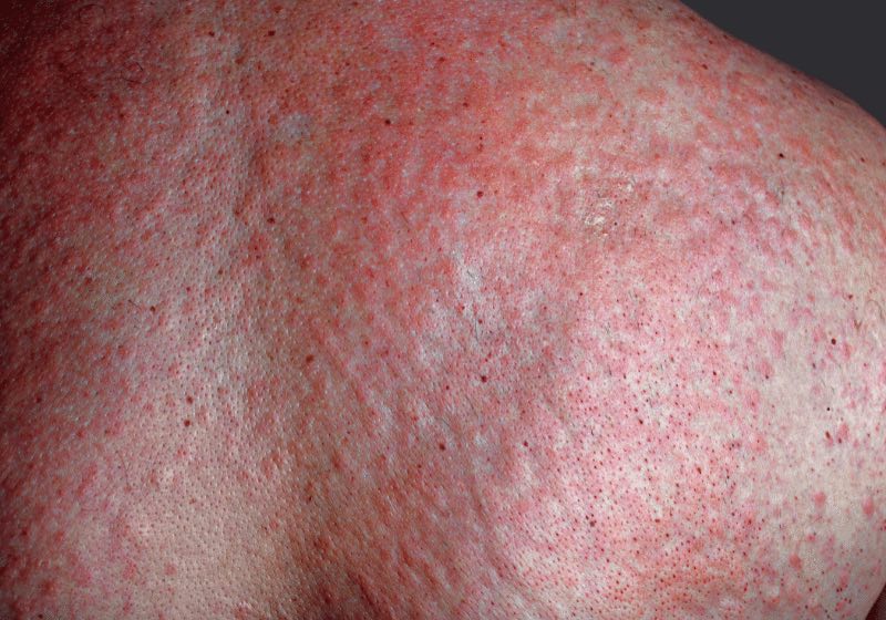 Lupus Rash Picture
