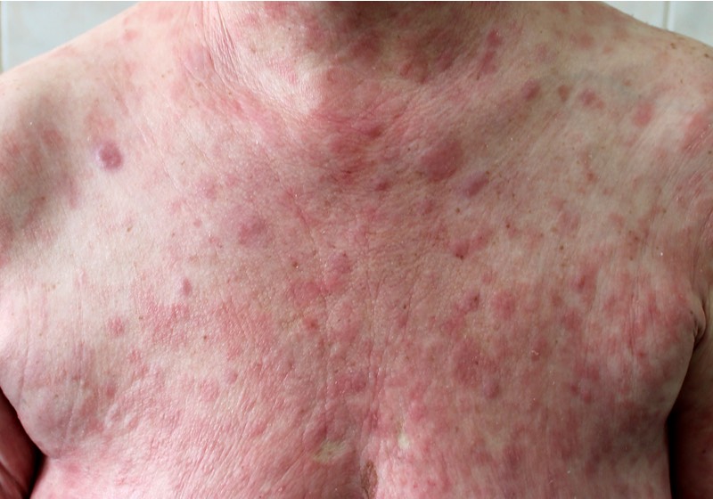 Mycosis fungoides (Cutaneous T-cell lymphoma) in a female.