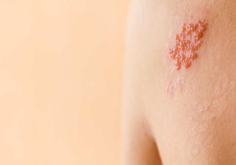 Shingles on men herpes zoster | Skin Manifestations Shingles Rash
