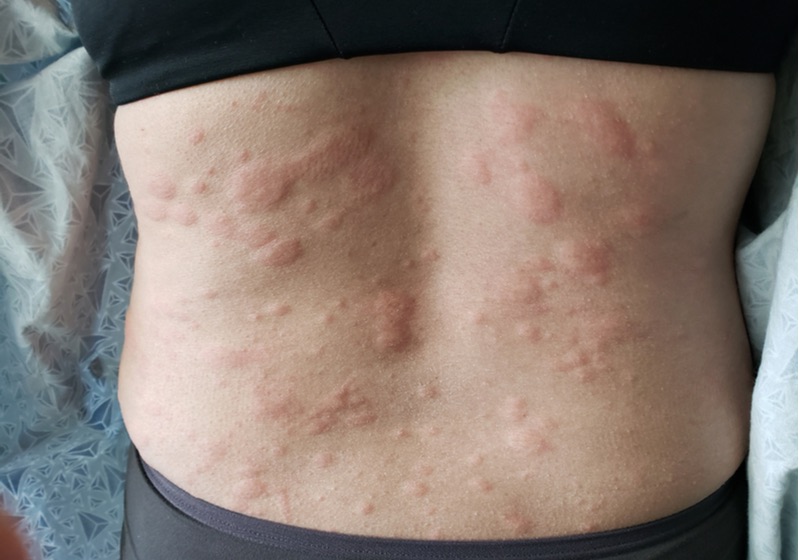 Urticaria or hives on the human back Skin Manifestations of Allergies