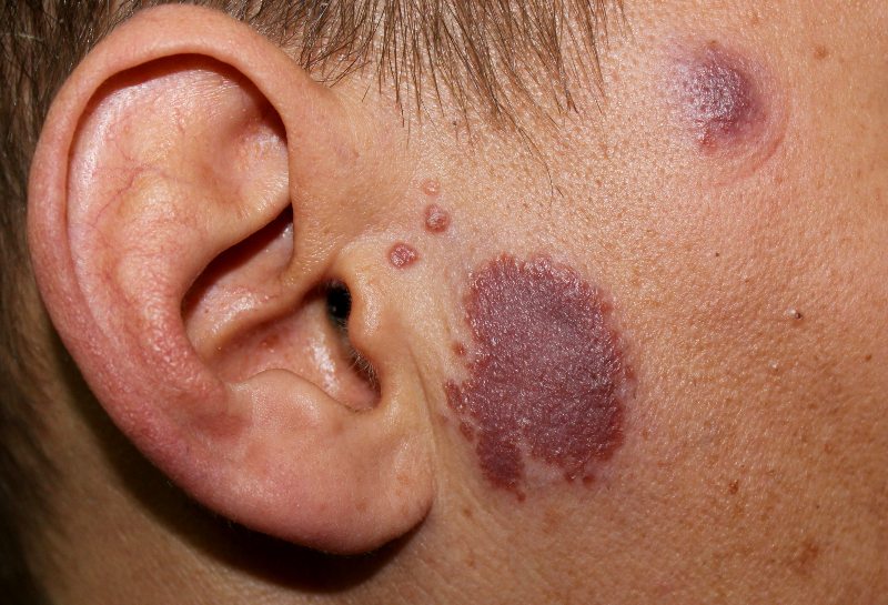 A Case of Cutaneous Sarcoidosis in a Young Man | Lupus Pernio