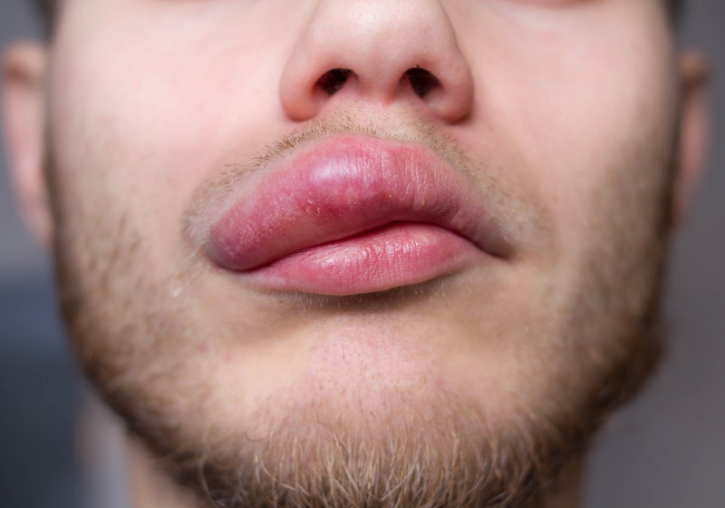angioedema. Allergic reaction to the lip. Hives