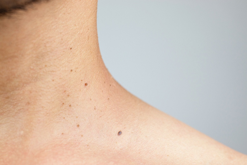 close skin problem polyps on neck | diabetes symptoms