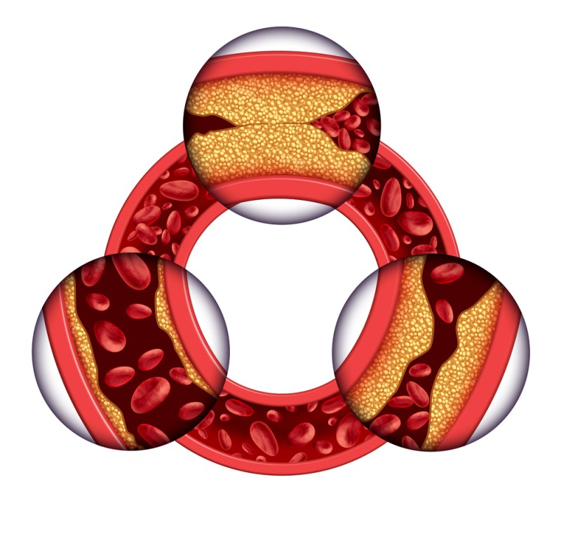 coronary artery disease medical concept circular | heart attack