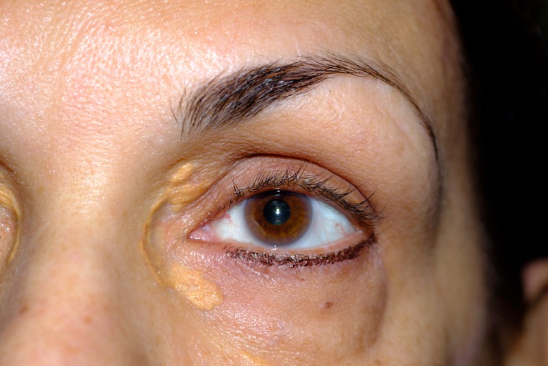 female patient presenting xanthelasma | signs of diabetes