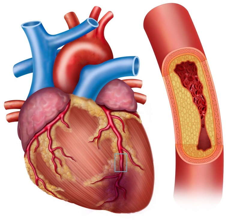 illustration heart coronary artery disease main | angina vs heart attack