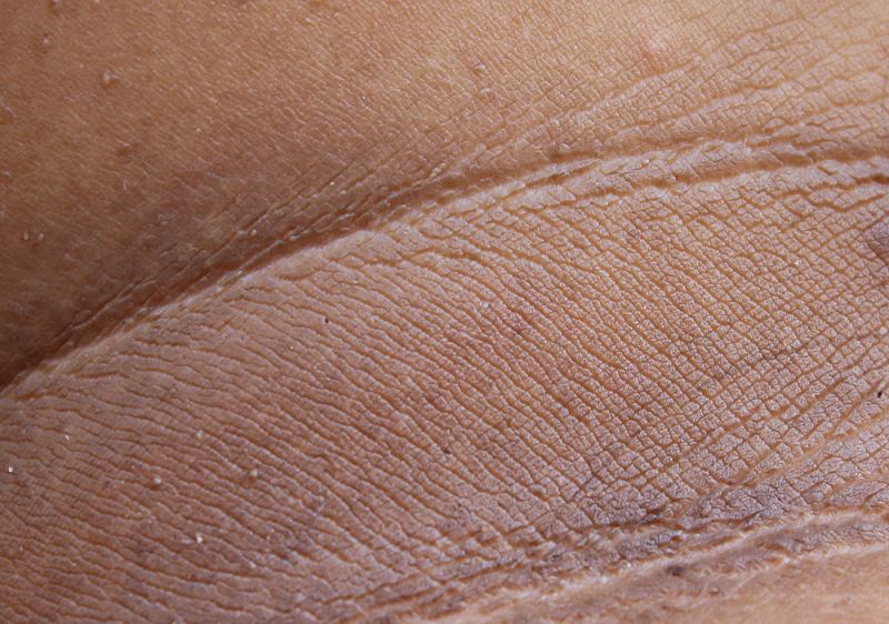 neck skin texture human woman | signs of diabetes