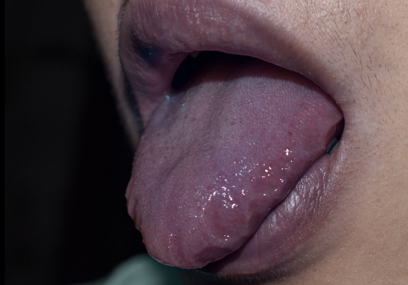 blue tongue human | BLue Tongue | TOngue COlor Meaning | Cyanotic lips or central cyanosis man with COVID-19 disease.