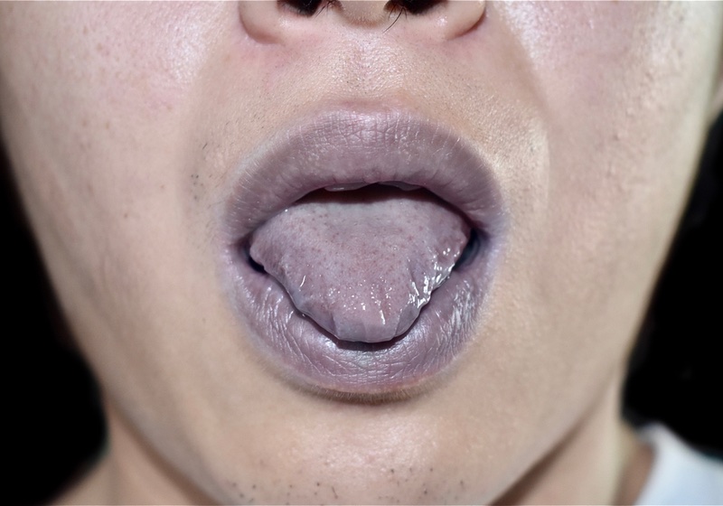 purple tongue pictures | Purple Tongue | Dark Purple Tongue | Tongue Color Meaning _ Cyanotic lips and tongue or central cyanosis at Southeast Asian, Chinese man with congenital heart disease