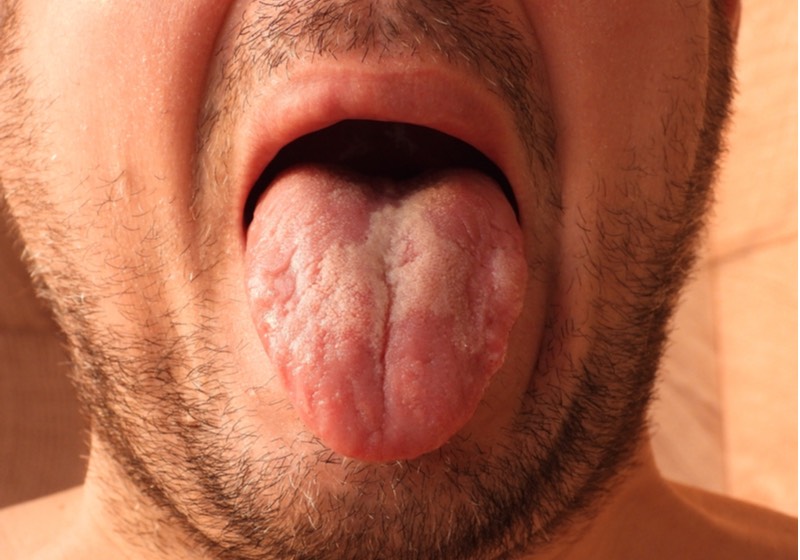 Geographic tongue color meaning is an inflammatory disease manifested by thick white patches lesions on the back of the tongue and on its sides.