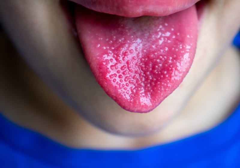 Red Tongue Meaning _ Red and Bumpy Tongue Color Meaning _ Strawberry tongue, sign of Streptococcus infection _ Scarlet Fever 