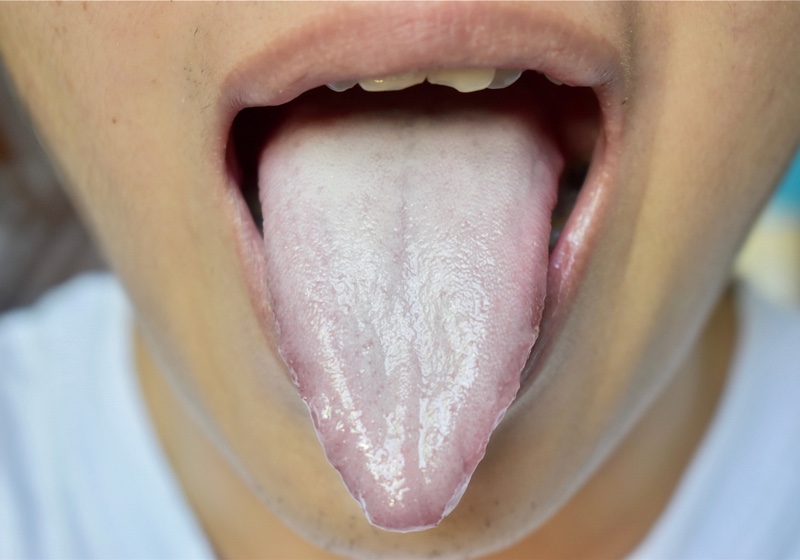 White Tongue | White Tongue Meaning | white tongue coating | Coated Tongue It appears with white layer when debris, bacteria and dead cells become lodged between enlarged papillae. Loss of taste called ageusia.