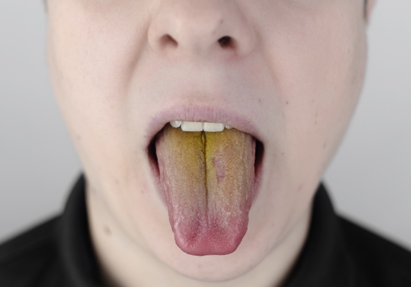 Yellow Tongue | What does Yellow Tongue Mean| Yellow Tongue Meaning | Yellow Tongue Causes The man has a yellow tongue. Painful yellow coating on the mucous membrane of the tongue. Diseases of the gastrointestinal tract, liver and gallbladder. The consequences of taking antibiotics.