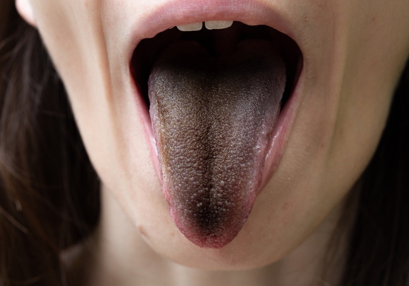 Black Tongue Covid | Black Tongue Meaning | Black Hairy Tongue | black hairy tongue images (enterobacter cloacae). A common symptom of a bacterial infection in the mouth.