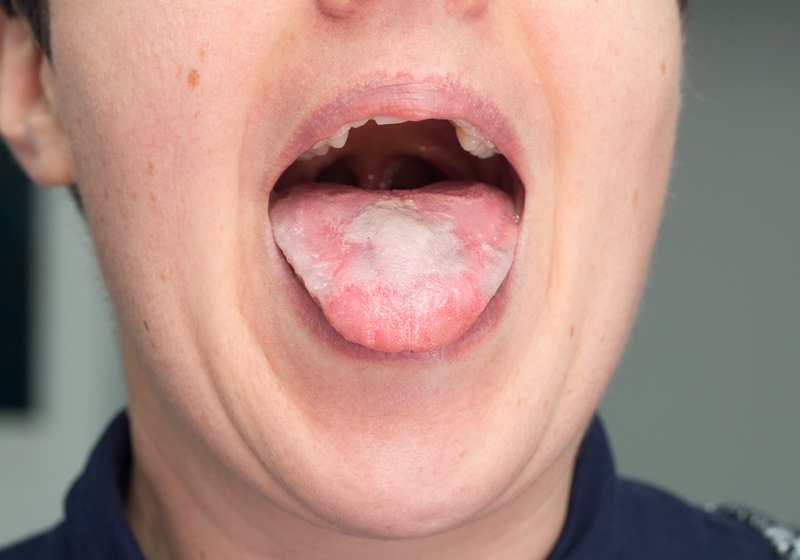 thick white coating on tongue| tongue infected by Candida albicans | White Tongue Color Meaning